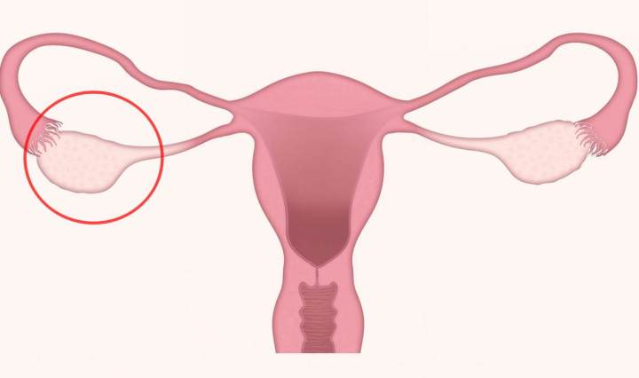 [รีวิว] รักษา “ถุงน้ำในรังไข่แตก” ด้วยสิทธิ์ประกันสังคม ไม่ต้องสำรองจ่าย