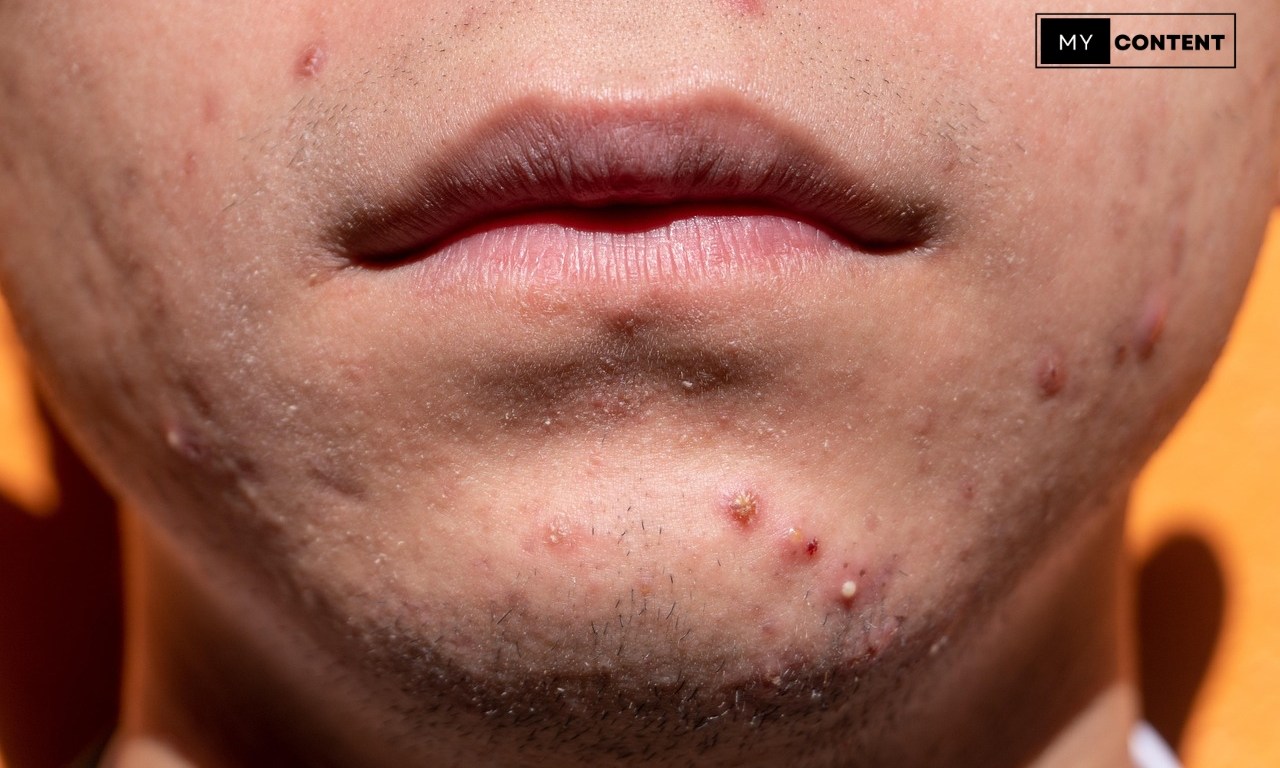 ลดรอยสิว ทำยังไงให้จางลงเร็วที่สุด