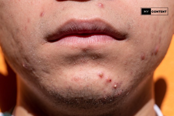 ลดรอยสิว ทำยังไงให้จางลงเร็วที่สุด